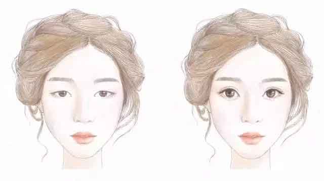 上海割双眼皮几天可以拆线