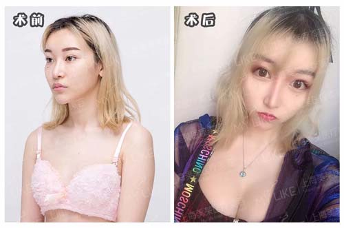 在上海做了双眼皮多久能消肿