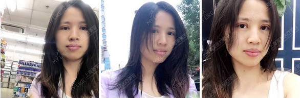 上海割双眼皮怎么消肿快