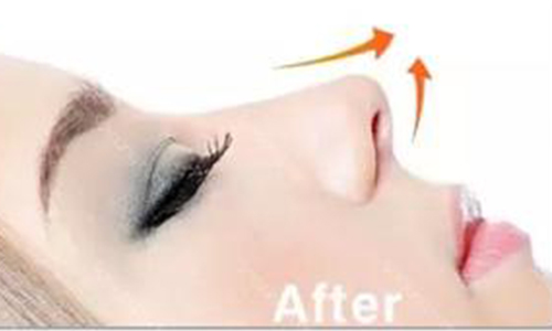 上海割双眼皮怎么消肿快