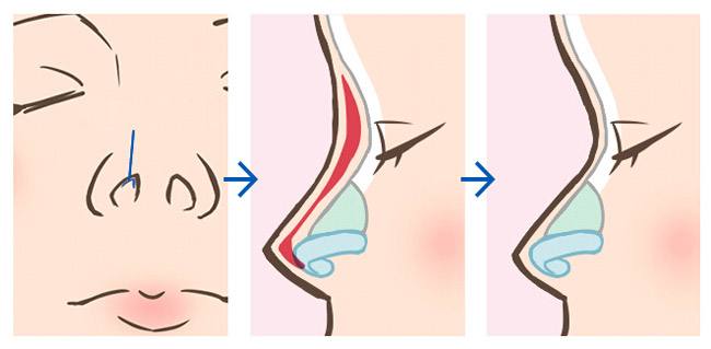 上海自体软骨隆鼻是永久吗