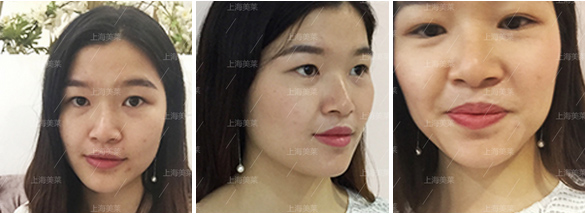 上海开眼角什么时候恢复自然