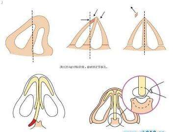 上海割双眼皮的方法有哪些