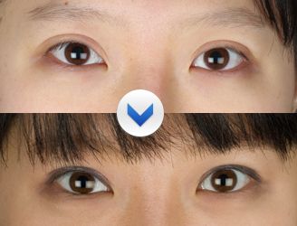 上海水光针注意事项有哪些