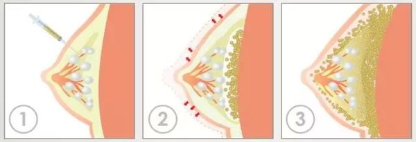 上海割双眼皮几天能消肿