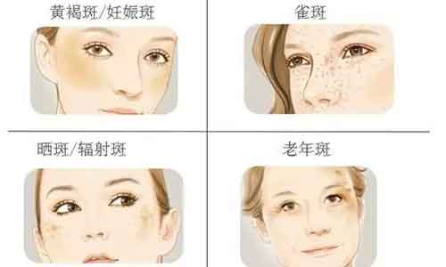 上海割双眼皮几天能消肿