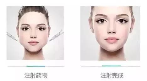 上海全切双眼皮的恢复期是多久