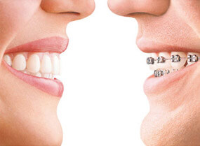 上海做自体软骨隆鼻多少钱