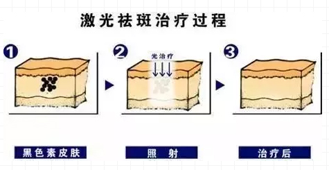 上海割双眼皮几天可以拆线呢