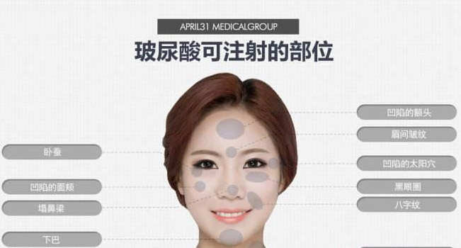 上海埋线的双眼皮能保持多久