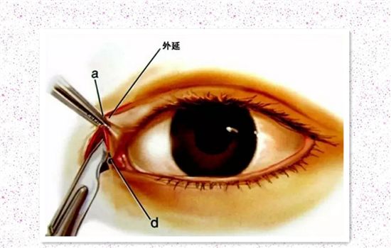上海全切双眼皮术后吃什么好
