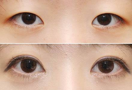 上海全切双眼皮术后吃什么好