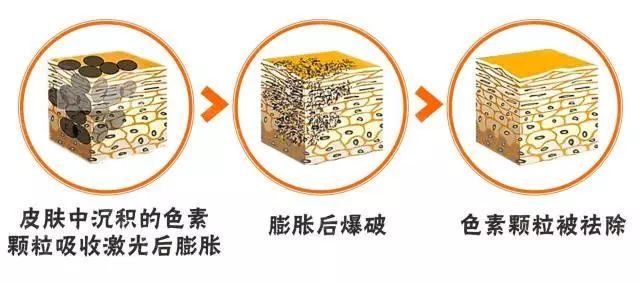 上海埋线双眼皮多久恢复可以上班