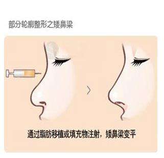 在上海18岁可以割双眼皮吗