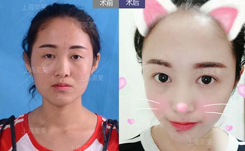 双眼皮失败如何修复,一年可以修复几次