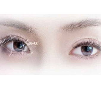 上海双眼皮美莱多久消肿