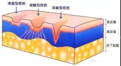 上海皮秒祛斑后要注意什么
