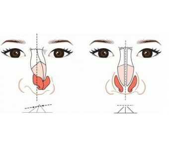 上海割双眼皮的恢复是多久,期间要注意什么