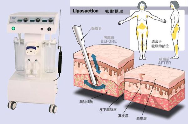 上海割双眼皮多久恢复自然