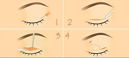 上海美莱开眼角一般多久恢复