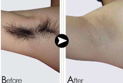 上海激光祛痘多少钱价格贵不贵