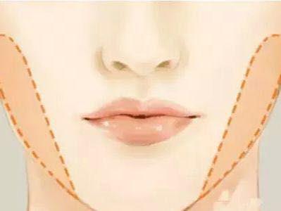 上海激光祛痘多少钱价格贵不贵