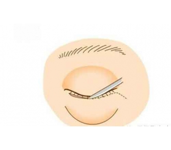 上海美莱全切双眼皮多久消肿