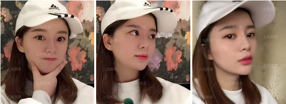 上海割双眼皮多久可以恢复