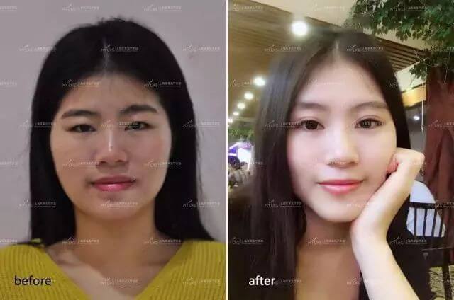 上海割双眼皮美莱怎么样