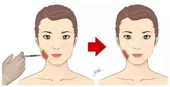 上海割双眼皮术前术后注意事项有哪些