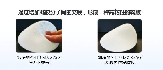 上海美莱割双眼皮多久能消肿