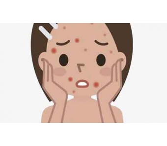 上海美莱割双眼皮多久能消肿