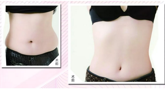 上海埋线双眼皮多少钱啊