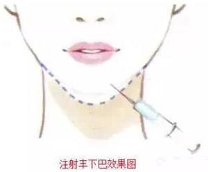 上海美莱割双眼皮的方法有哪些