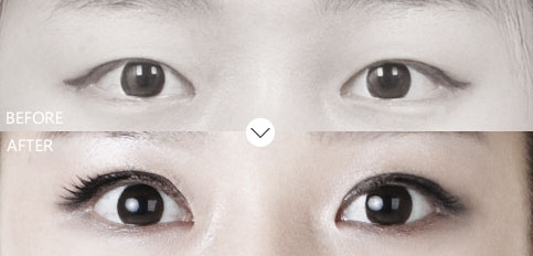 上海美莱割双眼皮的方法有哪些
