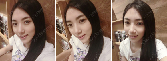 上海美莱埋线双眼皮多久恢复