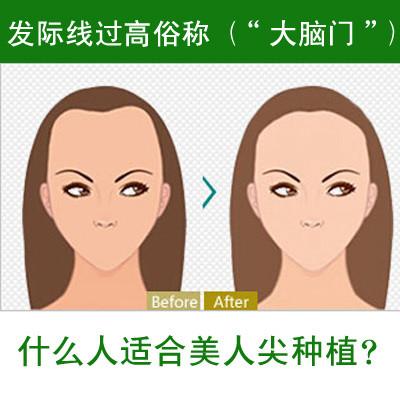 上海美莱打瘦脸针后注意事项