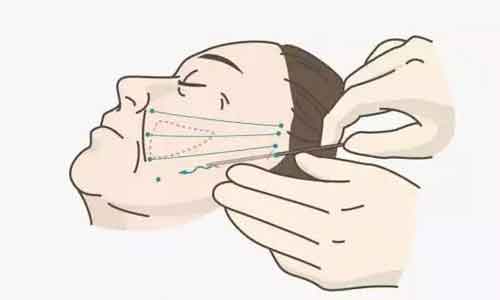 上海美莱激光除皱可以维持多久