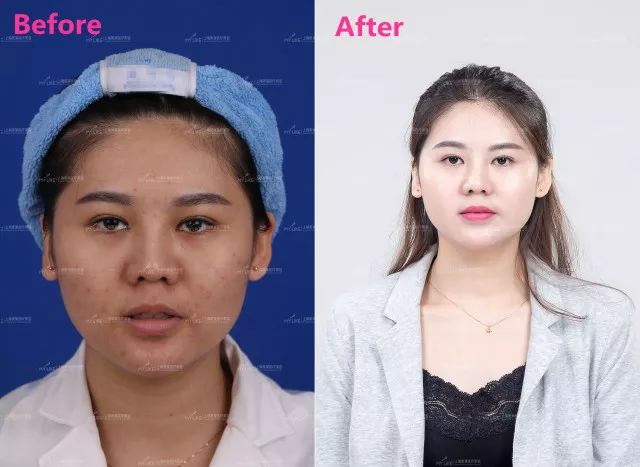 肿眼睛做双眼皮好吗，上海哪家医院做得好