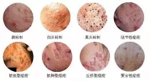 上海做鼻翼缩小整形手术好不好