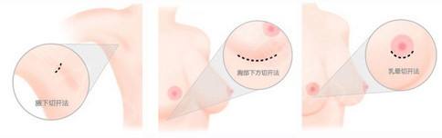 上海吸脂手臂吸脂后为什么会酸痛