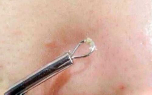 上海注射玻尿酸丰太阳穴有什么副作用吗