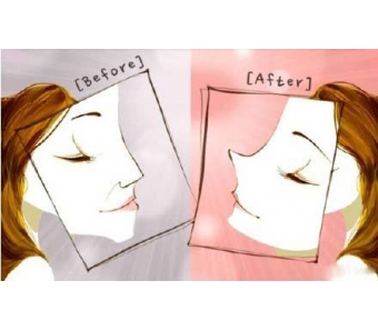 上海做激光祛痘美莱效果怎么样