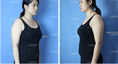 上海做鼻形矫正，歪鼻怎么进行矫正