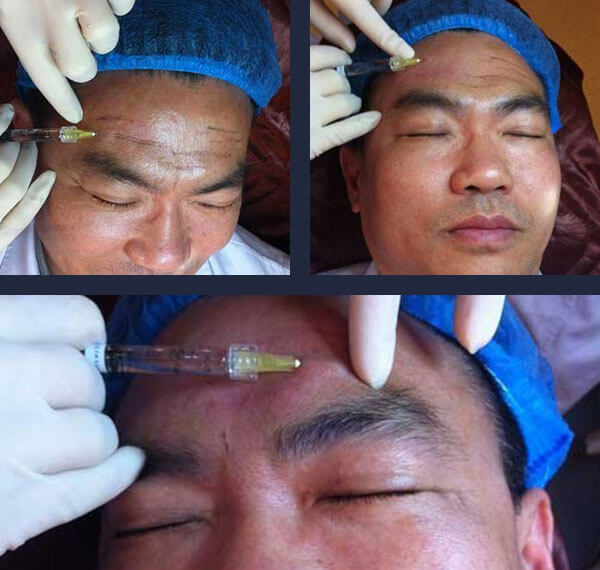 鼻翼缩小手术怎么样,有后遗症吗?