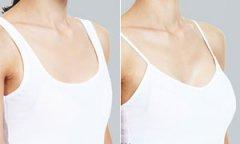 上海做双眼皮手术有哪几种方法 