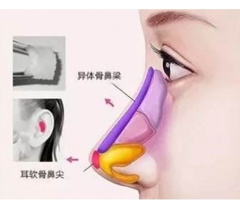 上海假体隆胸整形价格表是多少