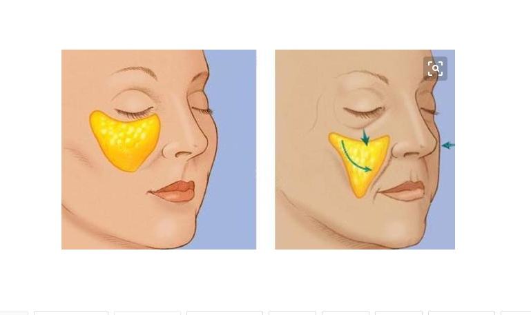 矫正歪鼻子大概需要多少钱
