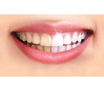 上海做激光脱毛安全吗?痛不痛?