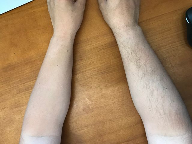 上海隆鼻,做了鼻翼缩小术后如何护理